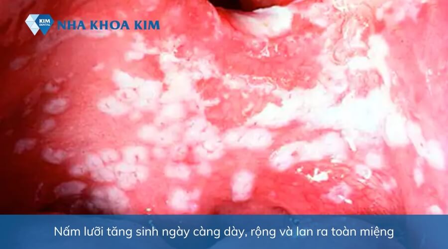 Hình ảnh nấm lưỡi đã lan rộng khắp khoang miệng