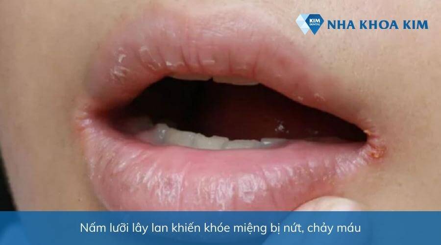 Hình ảnh bé bị nấm lưỡi gây nứt, chảy máu ở khóe miệng 