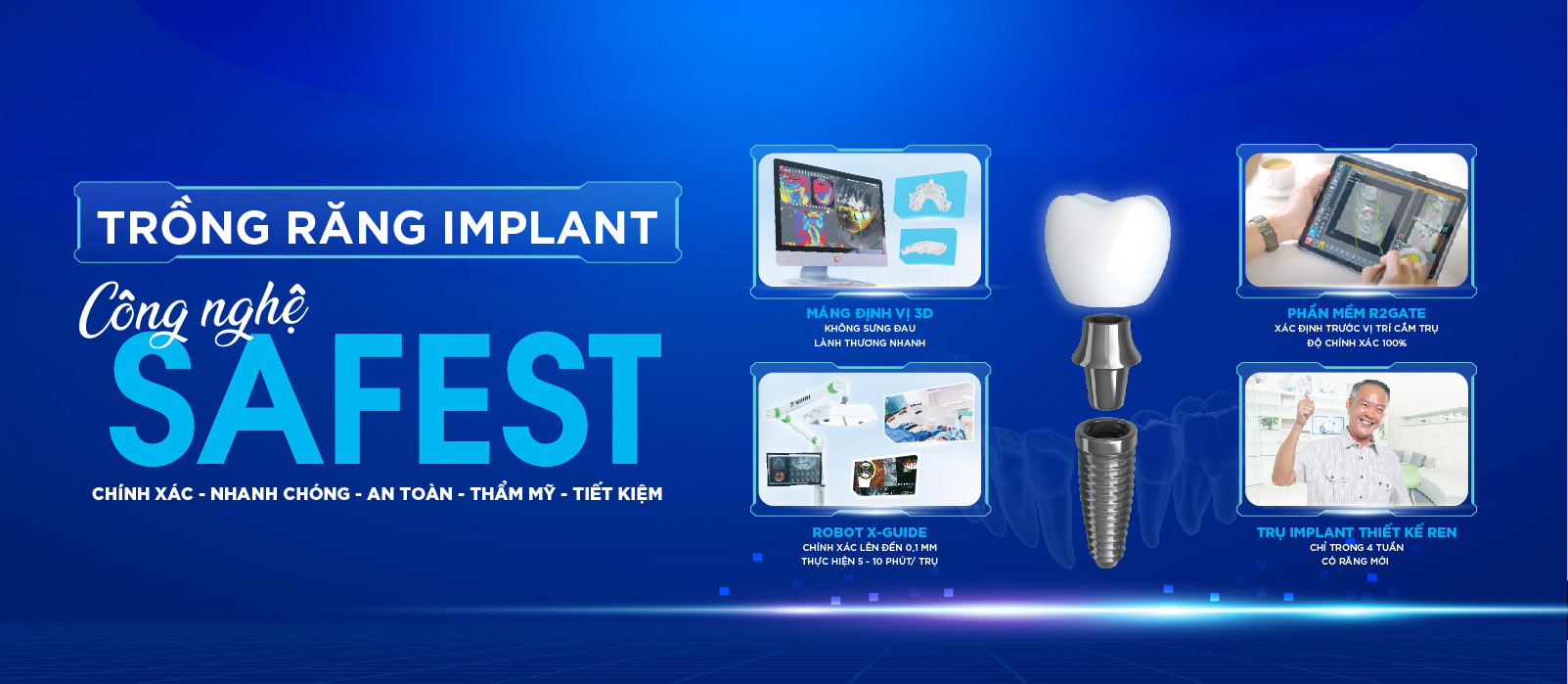 [Top Banner Mobile] Sáu lợi ích tuyệt vời cấy ghép răng implant bằng Robot định vị X-Guide
