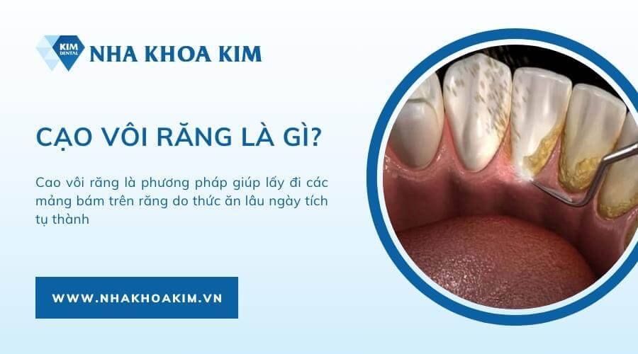 Cạo vôi răng là gì?