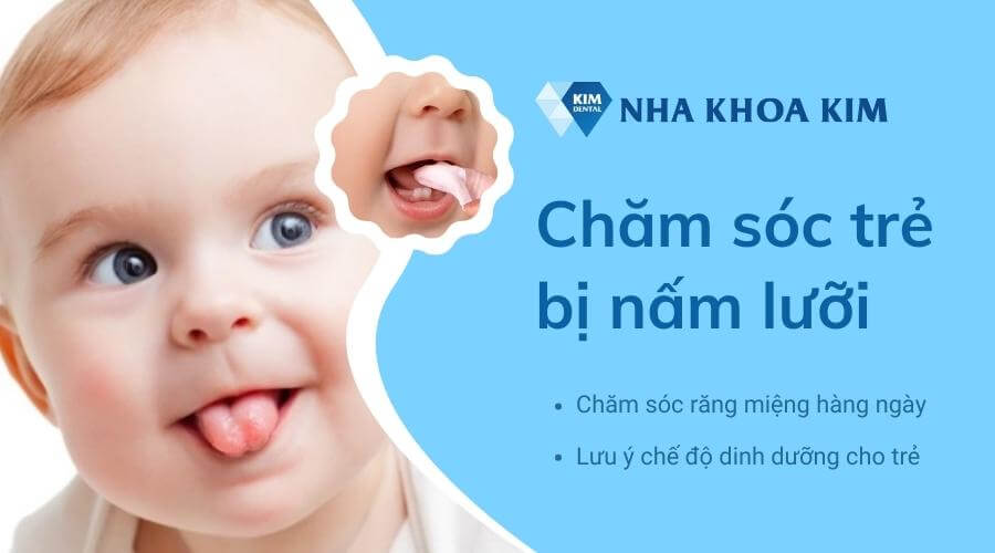 Các chăm sóc trẻ bị nấm lưỡi tại nhà