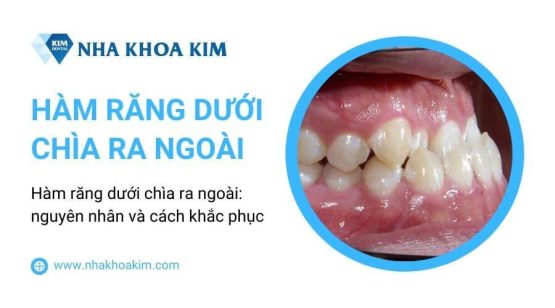 Hàm răng dưới chìa ra ngoài: nguyên nhân và cách khắc phục