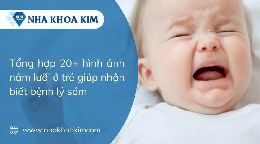 20+ Hình ảnh nấm lưỡi ở trẻ giúp mẹ nhận biết bệnh lý sớm