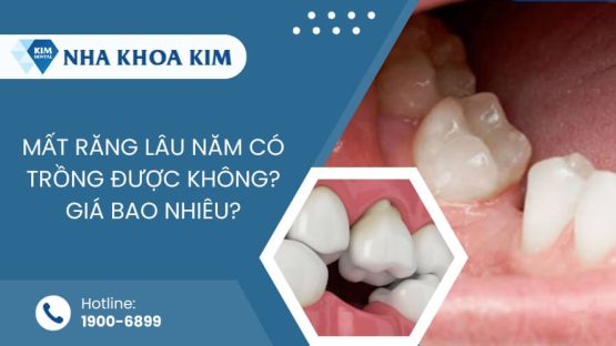 Mất răng lâu năm có trồng được không? Giá bao nhiêu?