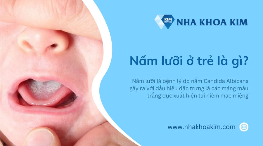 Nấm lưỡi ở trẻ là gì?