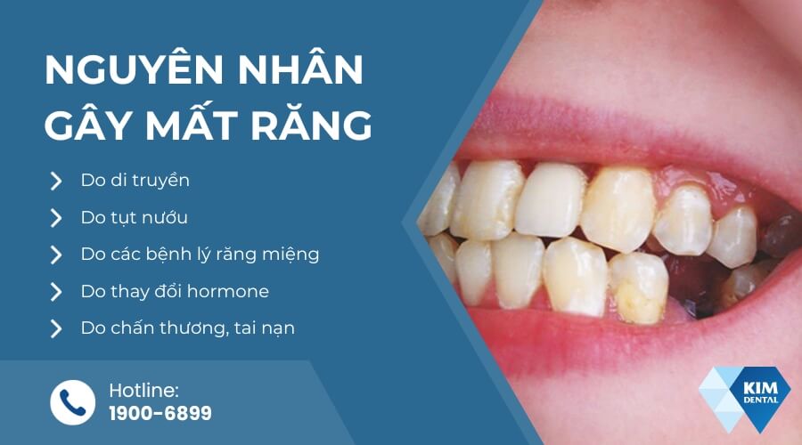 Nguyên nhân gây mất răng