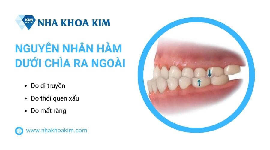 Nguyên nhân gây ra tình trạng hàm dưới chìa ra ngoài 