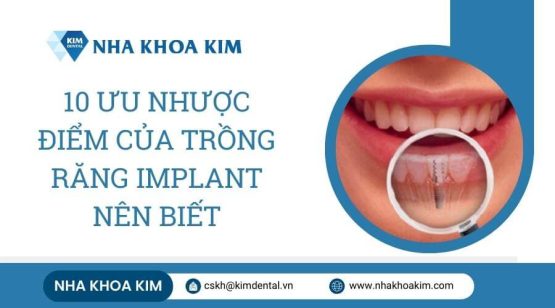 10 Ưu nhược điểm của trồng răng implant nên biết