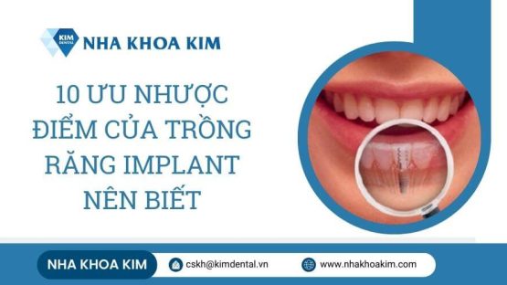 10 Ưu nhược điểm của trồng răng implant nên biết