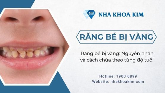 Răng bé bị vàng: Nguyên nhân và cách chữa theo từng độ tuổi