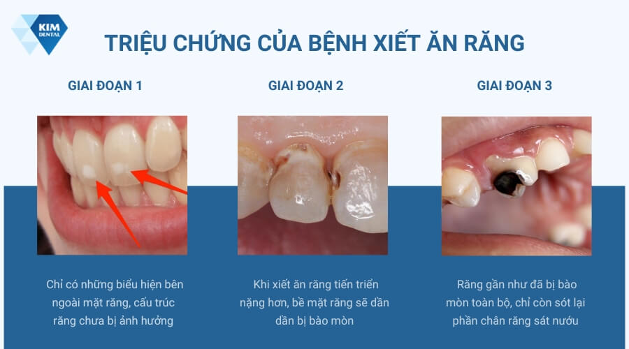 Triệu chứng của bệnh xiết ăn răng