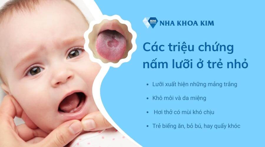 Các triệu chứng nấm lưỡi ở trẻ nhỏ