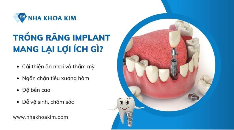 Trồng răng Implant mang lại lợi ích gì?
