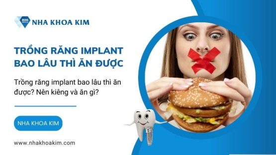 Trồng răng implant bao lâu thì ăn được? Nên kiêng và ăn gì?