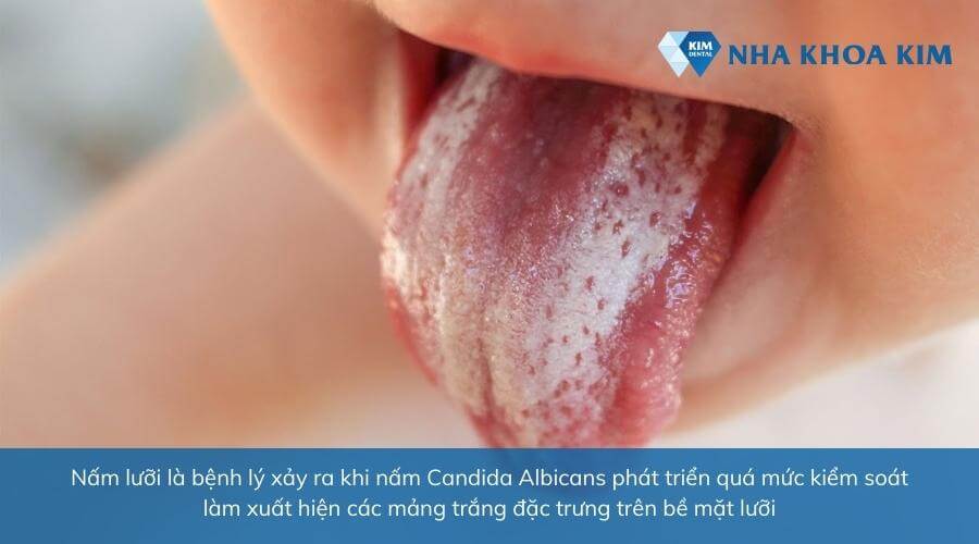 Nấm lưỡi là bệnh gì? 