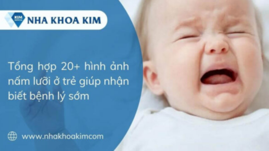 20+ Hình ảnh nấm lưỡi ở trẻ giúp mẹ nhận biết bệnh lý sớm