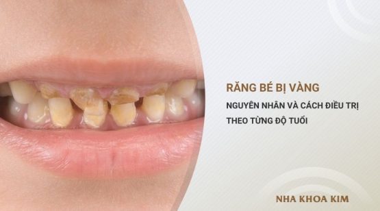 Răng bé bị vàng: Nguyên nhân và cách chữa theo từng độ tuổi