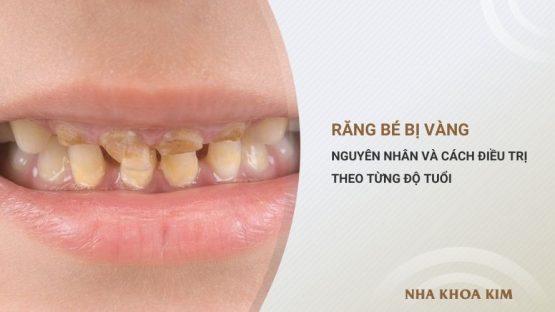 Răng bé bị vàng: Nguyên nhân và cách chữa theo từng độ tuổi