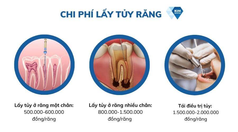 Lấy tủy bọc răng sứ giá bao nhiêu?