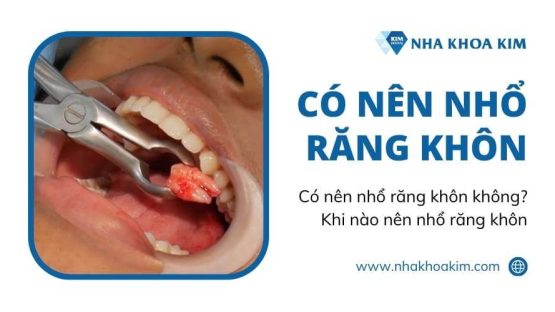 Có nên nhổ răng khôn không? Khi nào nên nhổ răng khôn