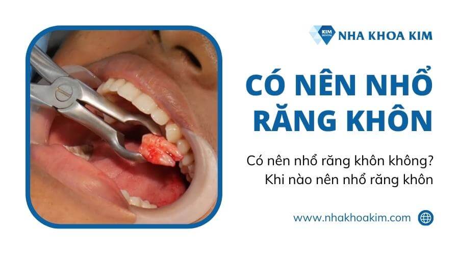 Có nên nhổ răng khôn không? Khi nào nên nhổ răng khôn