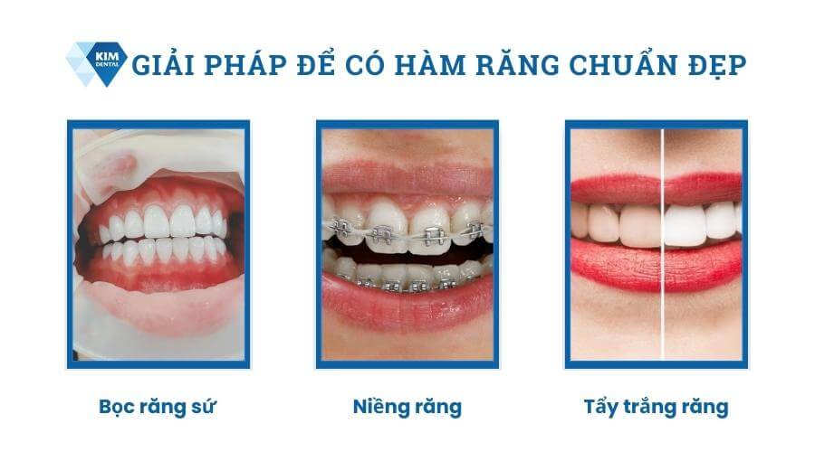 Giải pháp để có hàm răng chuẩn đẹp