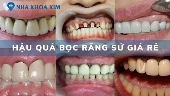 Hậu quả bọc răng sứ giá rẻ kém chất lượng cần cẩn trọng