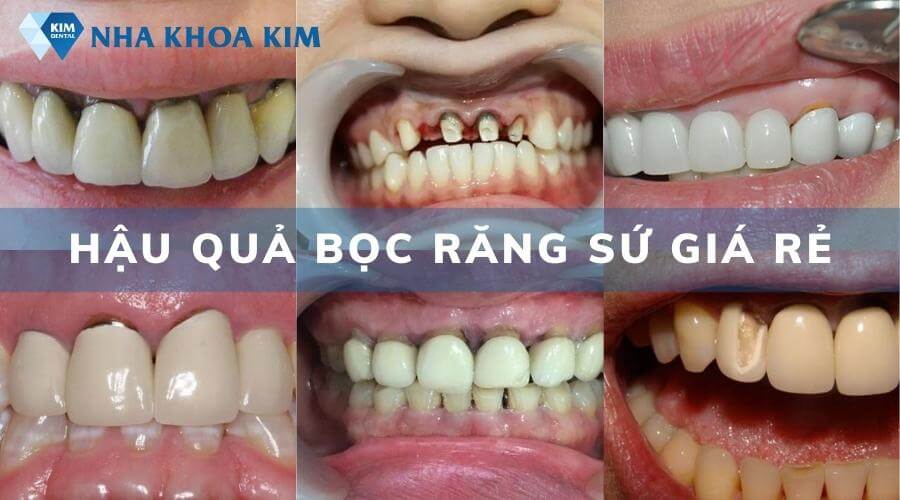 Hậu quả làm răng sứ: Những điều cần biết để tránh rủi ro