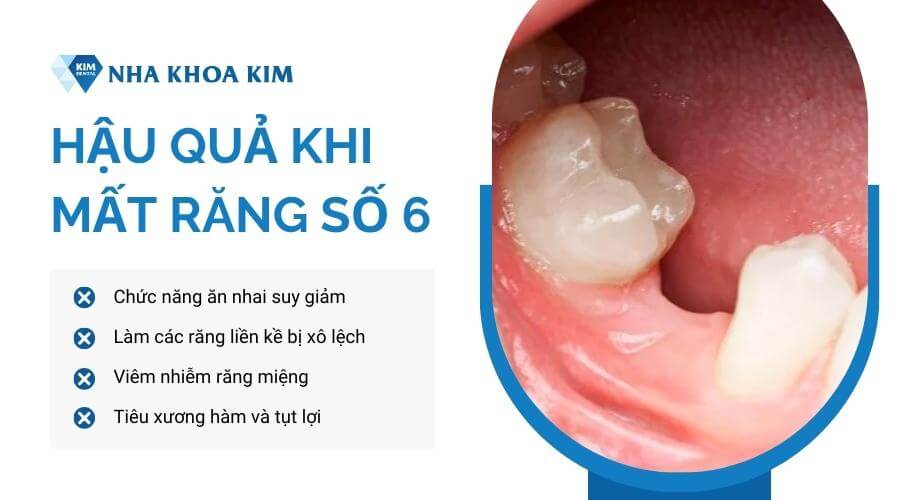 Hậu quả khi mất răng hàm số 6 là gì?