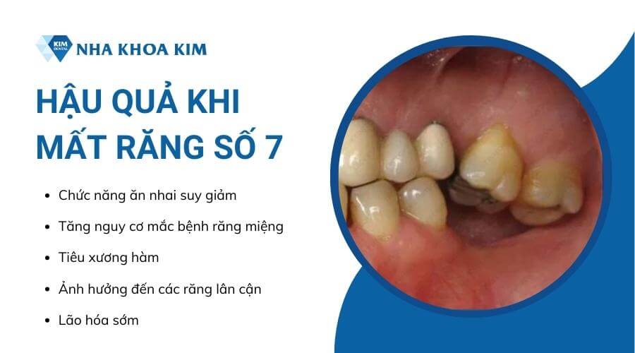 Hậu quả khi mất răng hàm số 7 là gì?