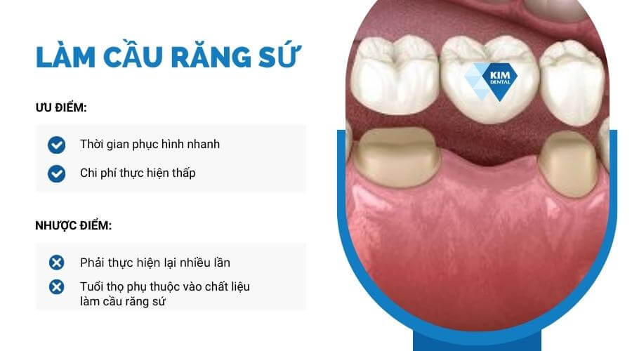 Phương pháp phục hình răng hàm số 6 bằng cầu răng sứ