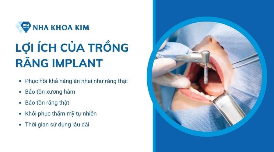 Có nên trồng răng Implant không? 