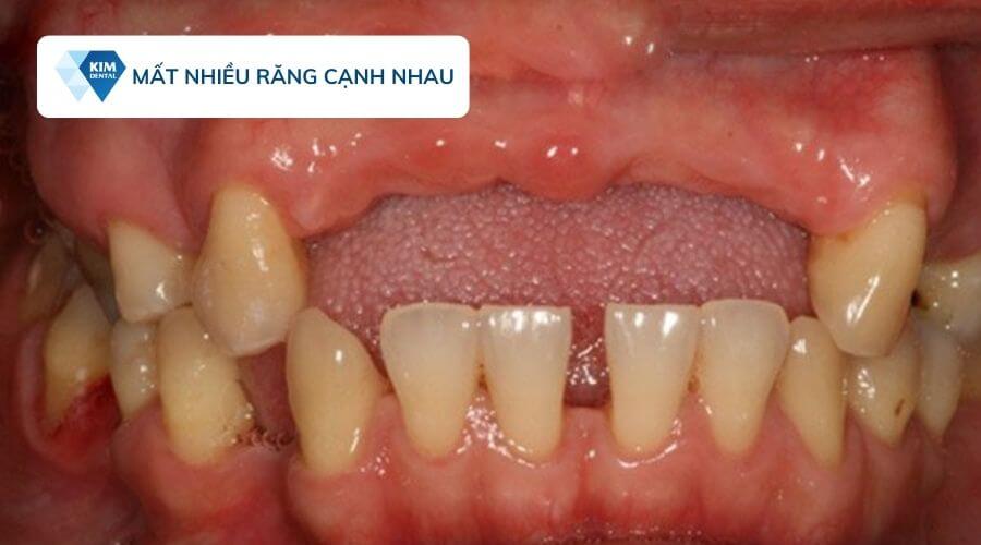 Trồng răng implant khi mất nhiều răng cạnh nhau