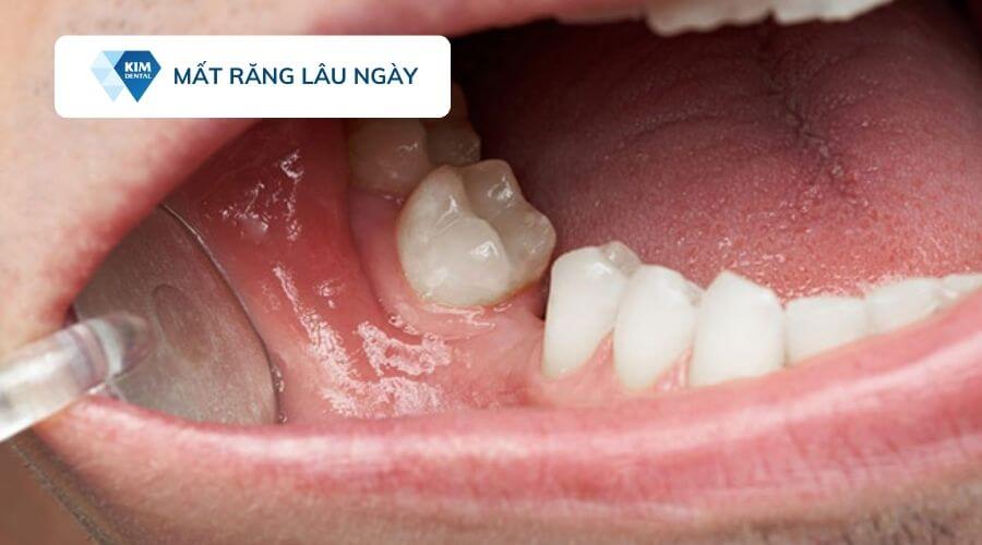 Mất răng lâu năm có trồng implant được không