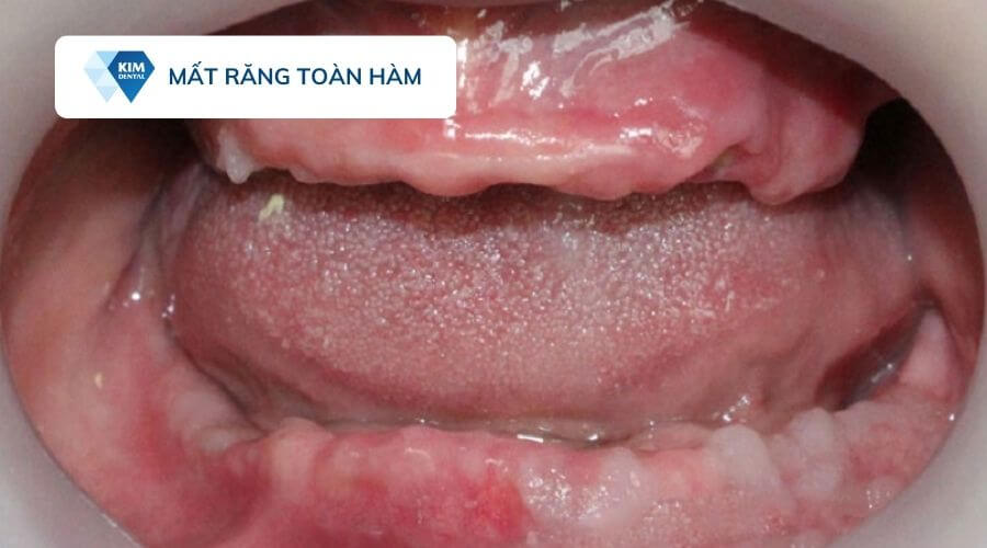 Mất răng toàn hàm có trồng implant được không