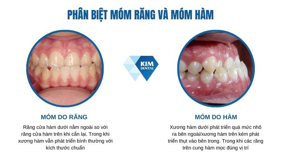 Phân biệt các loại móm răng hiện nay