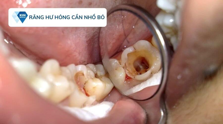 Ai là người nên trồng răng Implant?