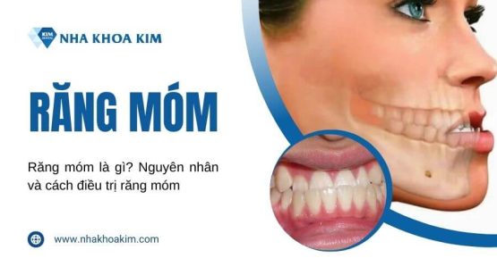 Răng móm là gì? Nguyên nhân và cách điều trị răng móm