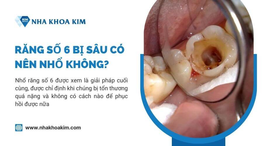 Răng số 6 bị sâu có nên nhổ không?