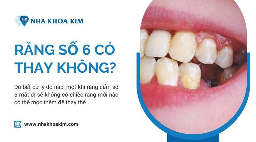 Răng Hàm Số 6 Có Thay Được Không? Hiểu Rõ Về Răng Cấm Vĩnh Viễn