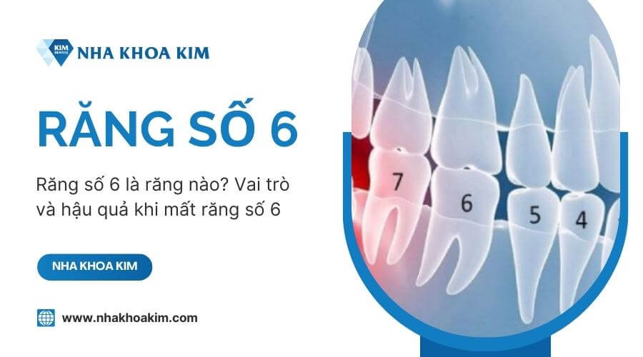 răng số 6 có thay không