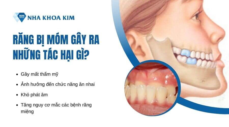 Những ảnh hưởng do răng bị móm gây ra