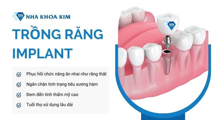 Phương pháp phục hình răng hàm số 6 bằng trồng răng implant