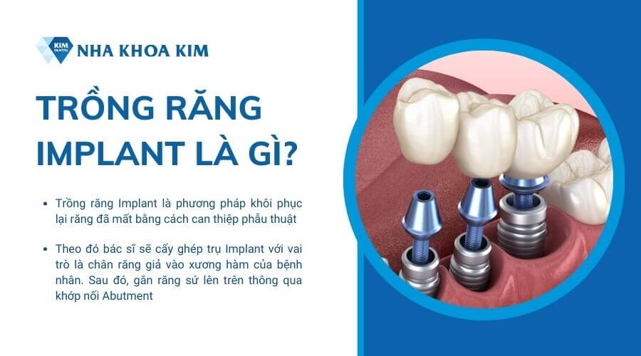 Trồng răng Implant là gì? 