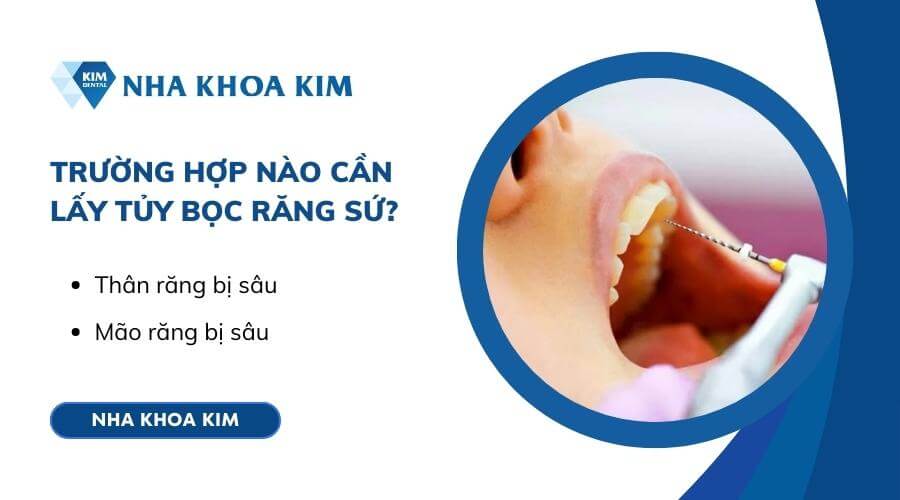 Trường hợp nào cần lấy tủy bọc răng sứ?