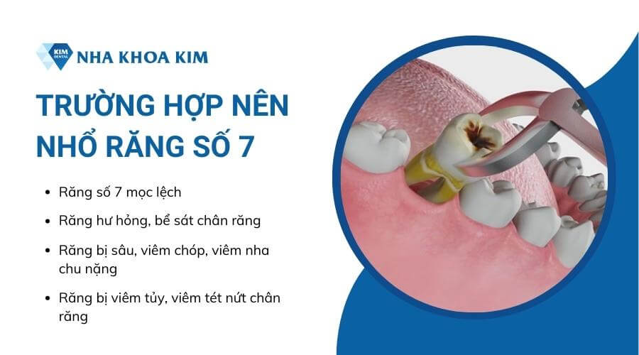 Răng số 7 bị sâu có nên nhổ không?