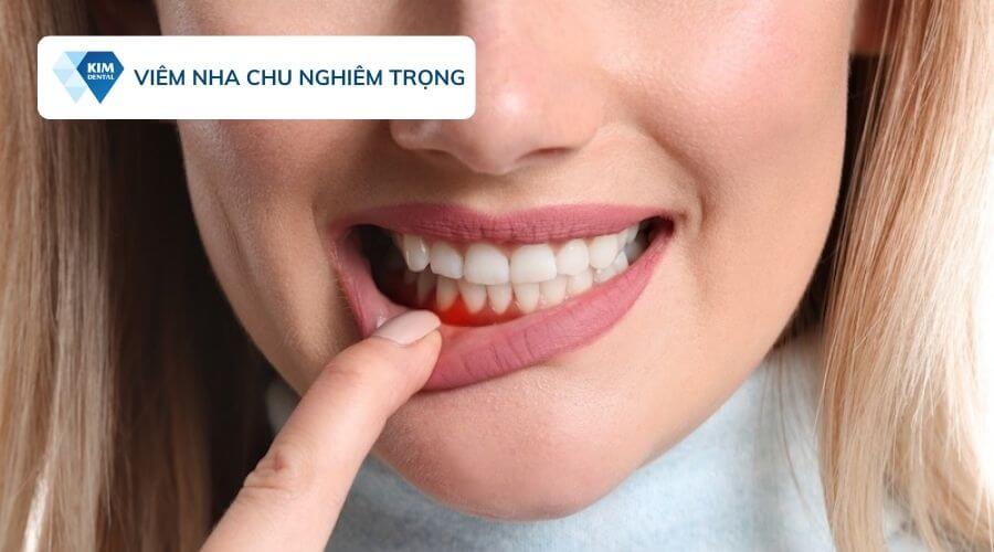 Viêm nha chu có nên trồng răng implant không?