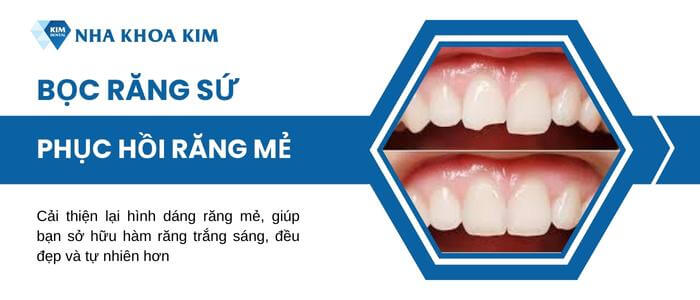 Bọc răng sứ răng bị mẻ