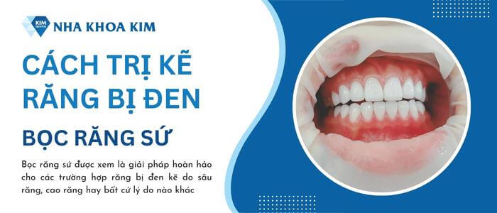 Bọc răng sứ khắc phục tình trạng răng bị đen ở kẽ