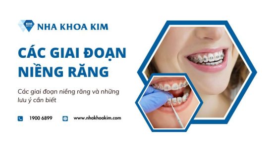 Các giai đoạn niềng răng và những lưu ý cần biết